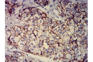 Immunohistochemical analysis of paraffin-embedded bladder cancer tissues using CD239 mouse mAb with DAB staining.