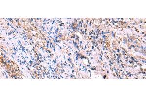 Immunohistochemistry of paraffin-embedded Human cervical cancer tissue using FUCA2 Polyclonal Antibody at dilution of 1:70(x200)