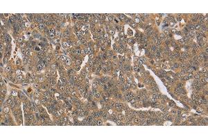 Immunohistochemistry of paraffin-embedded Human cervical cancer using PTPN12 Polyclonal Antibody at dilution of 1:45 (PTPN12 Antikörper)