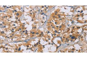 Immunohistochemistry of paraffin-embedded Human thyroid cancer tissue using NME5 Polyclonal Antibody at dilution 1:50 (NME5 Antikörper)