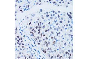 Immunohistochemistry of paraffin-embedded human lung cancer using TP53 antibody (ABIN4905469) at dilution of 1:100 (40x lens). (p53 Antikörper)