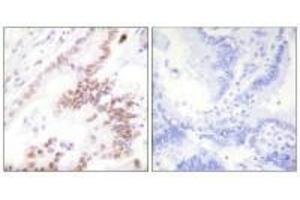 Immunohistochemistry analysis of paraffin-embedded human lung carcinoma tissue using p300 antibody. (PTGER3 Antikörper  (N-Term))