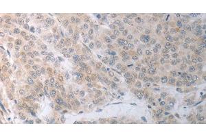 Immunohistochemistry of paraffin-embedded Human liver cancer using RBMS3 Polyclonal Antibody at dilution of 1:70 (RBMS3 Antikörper)