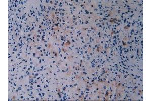 Detection of BRCA1 in Human Prostate Gland Cancer Tissue using Polyclonal Antibody to Breast Cancer Susceptibility Protein 1 (BRCA1) (BRCA1 Antikörper  (AA 19-83))