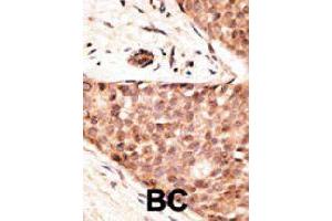 Formalin-fixed and paraffin-embedded human cancer tissue reacted with CDX2 polyclonal antibody  , which was peroxidase-conjugated to the secondary antibody, followed by AEC staining.