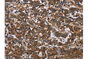The image on the left is immunohistochemistry of paraffin-embedded Human liver cancer tissue using ABIN7191586(NCKAP1 Antibody) at dilution 1/30, on the right is treated with synthetic peptide. (NCKAP1 Antikörper)