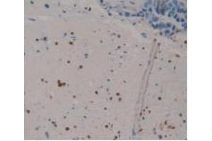 IHC-P analysis of Human Breast Cancer Tissue, with DAB staining. (S100P Antikörper  (AA 1-95))