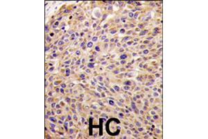 Formalin-fixed and paraffin-embedded human hepatocellular carcinoma reacted with GGPS1 polyclonal antibody  , which was peroxidase-conjugated to the secondary antibody, followed by DAB staining . (GGPS1 Antikörper  (N-Term))