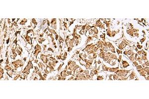 Immunohistochemistry of paraffin-embedded Human breast cancer tissue using MECR Polyclonal Antibody at dilution of 1:70(x200) (MECR Antikörper)