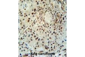 ABHEB Antibody (C-term) immunohistochemistry analysis in formalin fixed and paraffin embedded human lung carcinoma followed by peroxidase conjugation of the secondary antibody and DAB staining.