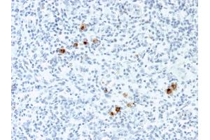 Formalin-fixed, paraffin-embedded human Hodgkin's Lymphoma stained with EBV Mouse Monoclonal Antibody (CS-4). (EBV LMP1 Antikörper)