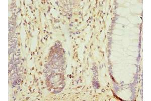 Immunohistochemistry of paraffin-embedded human colon cancer using ABIN7148064 at dilution of 1:100 (CCDC16 Antikörper  (AA 1-280))