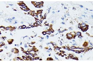 Immunohistochemistry of paraffin-embedded Human lung cancer using MMP25 Polyclonal Antibody at dilution of 1:100 (40x lens). (MMP25 Antikörper)