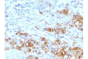 Formalin-fixed, paraffin-embedded human Gastric Carcinoma stained with CA19-9 Rabbit Recombinant Monoclonal Antibody (CA19. (CA 19-9 Antikörper)
