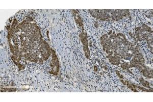 IHC analysis of PARP using anti-PARP antibody (ABIN7602277). (PARP1 Antikörper  (AA 670-858))
