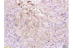 Formalin-fixed and paraffin embedded human cervical carcinoma labeled Anti-HIF-1-Alpha Polyclonal Antibody (ABIN672546), Unconjugated at 1:300, followed by conjugation to the secondary antibody and DAB staining (HIF1A Antikörper  (AA 341-450))