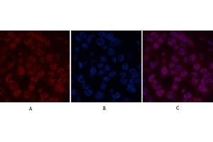 Immunofluorescence analysis of human liver cancer tissue. (Histone H2B Antikörper)