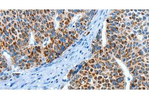 Immunohistochemistry of paraffin-embedded Human liver cancer using ALDH4A1 Polyclonal Antibody at dilution of 1:45 (ALDH4A1 Antikörper)