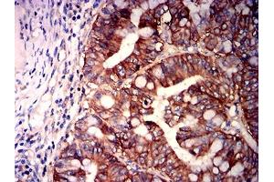 Immunohistochemical analysis of paraffin-embedded rectum cancer tissues using CD147 mouse mAb with DAB staining. (CD147 Antikörper  (AA 138-323))