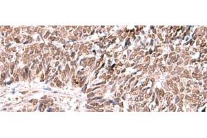 Immunohistochemistry of paraffin-embedded Human lung cancer tissue using FDPS Polyclonal Antibody at dilution of 1:60(x200) (FDPS Antikörper)