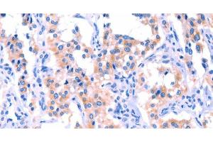 Immunohistochemistry of paraffin-embedded Human thyroid cancer tissue using ERN2 Polyclonal Antibody at dilution 1:40 (ERN2 Antikörper)