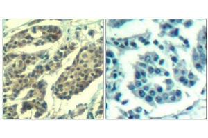 Immunohistochemical analysis of paraffin-embedded human breast carcinoma tissue using Cyclin B1(Phospho-Ser147) Antibody(left) or the same antibody preincubated with blocking peptide(right). (Cyclin B1 Antikörper  (pSer147))