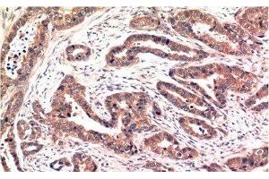 Immunohistochemistry of paraffin-embedded Human breast carcinoma tissue using Phospho-AKT1 (Ser473) Monoclonal Antibody at dilution of 1:200 (AKT1 Antikörper  (pSer473))