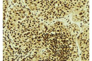 ABIN6276991 at 1/100 staining Human breast cancer tissue by IHC-P.