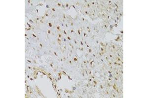 Immunohistochemistry of paraffin-embedded human leiomyoma of uterus using HNRNPA1 Antibody (ABIN5975570) at dilution of 1/100 (40x lens). (HNRNPA1 Antikörper)