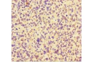 Immunohistochemistry of paraffin-embedded human glioma using ABIN7165362 at dilution of 1:100 (FAM117B Antikörper  (AA 1-200))