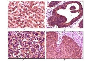 Immunohistochemical analysis of paraffin-embedded human liver tissue (A), colon carcinoma (B), lung carcinoma (C) and esophagus tissue (D), showing membrane localization using CK1 mouse mAb with DAB staining.