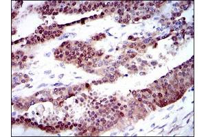 Immunohistochemical analysis of paraffin-embedded ovarian cancer tissues using CYP1A1 mouse mAb with DAB staining. (CYP1A1 Antikörper)
