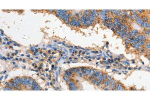 Immunohistochemistry of paraffin-embedded Human colon cancer using FAS Polyclonal Antibody at dilution of 1:60 (FAS Antikörper)