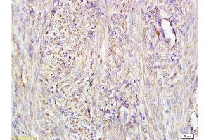 Formalin-fixed and paraffin embedded human cervical carcinoma labeled with Mouse Anti-AFP(A4) Monoclonal Antibody, Unconjugated (bsm-1622M) at 1:200 followed by conjugation to the secondary antibody and DAB staining. (alpha Fetoprotein Antikörper)