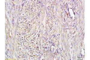 Formalin-fixed and paraffin embedded human cervical carcinoma labeled with Mouse Anti-AFP(A4) Monoclonal Antibody, Unconjugated (bsm-1622M) at 1:200 followed by conjugation to the secondary antibody and DAB staining.