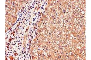 Immunohistochemistry of paraffin-embedded human liver cancer using ABIN7150398 at dilution of 1:100 (IGHMBP2 Antikörper  (AA 646-884))