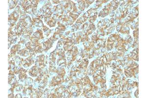 Formalin-fixed, paraffin-embedded human Thyroid Carcinoma stained with EpCAM Rabbit Recombinant Monoclonal Antibody (EGP40/1555R). (Rekombinanter EpCAM Antikörper  (N-Term))