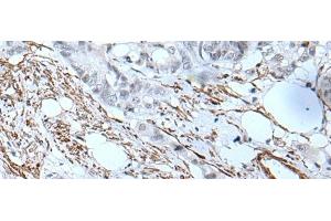 Immunohistochemistry of paraffin-embedded Human colorectal cancer tissue using GJA5 Polyclonal Antibody at dilution of 1:50(x200) (Cx40/GJA5 Antikörper)