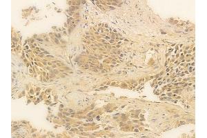 ABIN6256220 and ABIN6267281 at 1/100 staining human lung squamous cell carcinoma by IHC-P.
