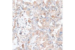 Immunohistochemistry of paraffin-embedded human lung cancer using HMGCR antibody (ABIN6293218) at dilution of 1:100 (40x lens).