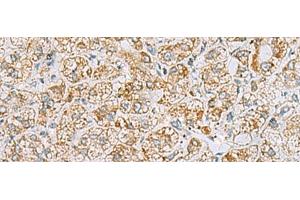 Immunohistochemistry of paraffin-embedded Human liver cancer tissue using INS(C-peptide) Polyclonal Antibody at dilution of 1:40(x200) (Insulin C-Peptide Antikörper)