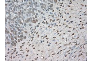 Immunohistochemical staining of paraffin-embedded Adenocarcinoma of colon tissue using anti-BUB1Bmouse monoclonal antibody. (BUB1B Antikörper)