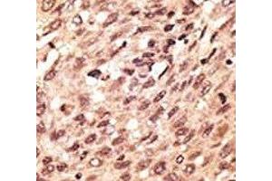 IHC analysis of FFPE human hepatocarcinoma stained with the LRP5 antibody