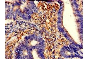 Immunohistochemistry of paraffin-embedded human colon cancer using ABIN7173558 at dilution of 1:100 (TPM3 Antikörper  (AA 18-224))