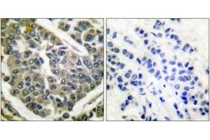 Immunohistochemistry analysis of paraffin-embedded human breast carcinoma tissue, using Collagen IV Antibody. (Collagen IV Antikörper  (AA 11-60))