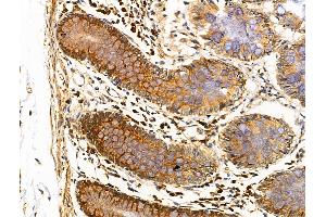 ABIN6257141 and ABIN6274489 at 1/100 staining Human colorectal cancer and adjacent normal tissues by IHC-P.