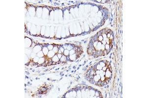 Immunohistochemistry of paraffin-embedded human colon using PTP4 antibody (ABIN7269703) at dilution of 1:100 (40x lens). (PTP4A2 Antikörper  (AA 30-100))