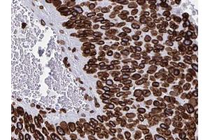 ABIN6268709 at 1/100 staining human Pancreas cancer tissues sections by IHC-P. (Lamin B Antikörper)