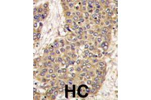 Formalin-fixed and paraffin-embedded human hepatocellular carcinoma reacted with CASP6 polyclonal antibody  , which was peroxidase-conjugated to the secondary antibody, followed by DAB staining.