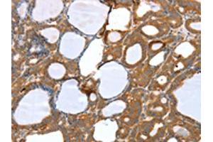 The image on the left is immunohistochemistry of paraffin-embedded Human thyroid cancer tissue using ABIN7131122(SNX11 Antibody) at dilution 1/30, on the right is treated with fusion protein. (SNX11 Antikörper)